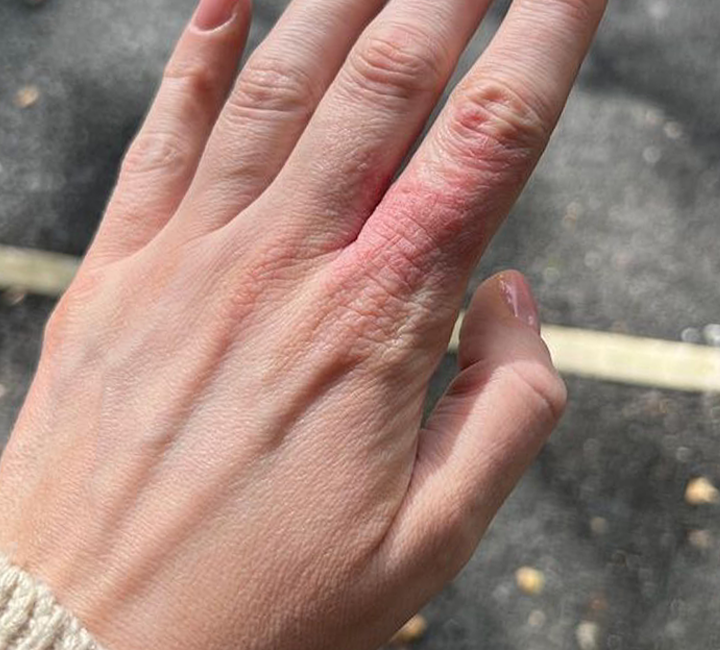 Labology 3 Customer review before photo using alcohol hand sanitisers and disinfectants_nail tech with skin allergy